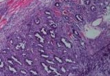 Pancreatic Cancer: Where We Are