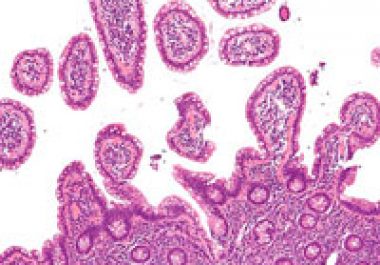 From the Journals: Keys to Understanding Acquired Ibrutinib Resistance in Mantle Cell Lymphoma