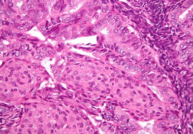 Combining Immunotherapy and Targeted Therapy to Treat Endometrial Cancer 