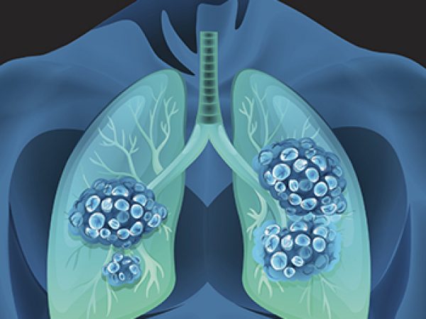 Advancing Lung Cancer Research