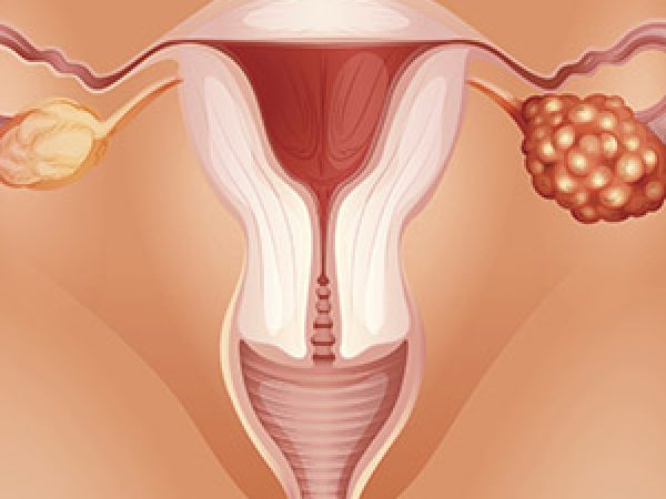 Ovarian Cancer: Unique Challenges and Opportunities for Progress