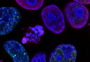 FDA Approves a Combination Chemotherapy for Advanced Colorectal Cancer