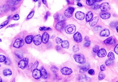 A New Treatment Option for Advanced Thyroid Cancer 