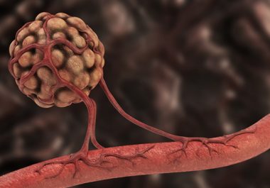 A New Treatment Option for Advanced Kidney Cancer