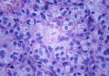 FDA Expands Use for Anticancer Therapeutic