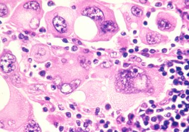 New Immunotherapeutic Tested in Clinical Trial