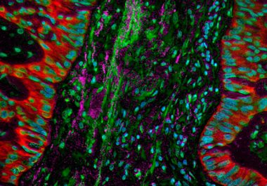 New Immunotherapy Option for Treating Metastatic Lung Cancer