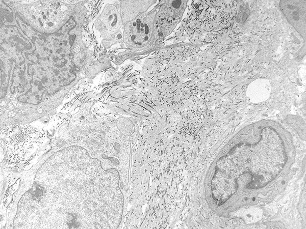 olaratumb soft tissue sarcoma