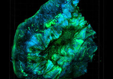 Ovarian Cancer: Examining the Microenvironment and Mutational Landscapes to Tailor Treatments