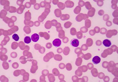 Molecularly Targeted Therapeutic Approved for Another Type of Non-Hodgkin Lymphoma