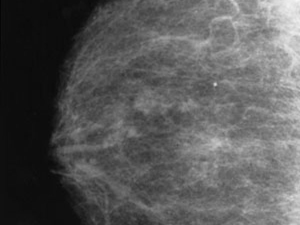 Mammography Screening: Benefits and Potential Risks