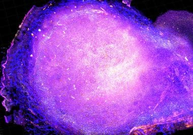 Another Immunotherapy Approved for Bladder Cancer