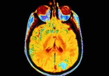 What Advances are Researchers Making in Treating Glioblastoma, McCain’s Cancer?