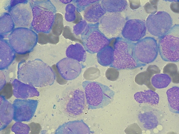 vyzeos to treat leukemia