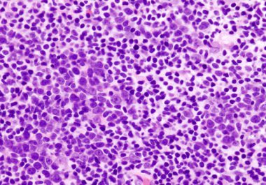Non-Hodgkin Lymphoma