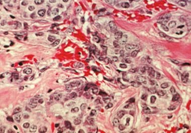 Identifying Breast Cancer Patients Likely to Respond to Chemotherapy