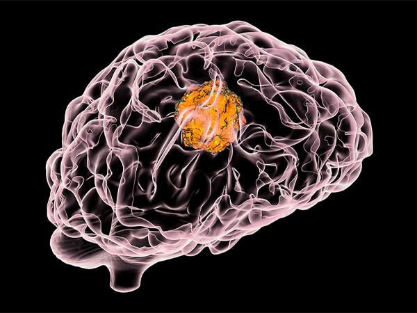 brain metastasis melanoma with immunotherapy