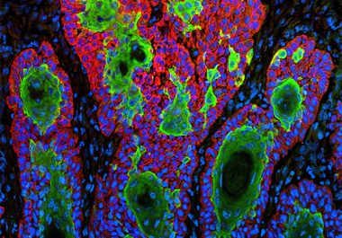 New Immunotherapeutic Approved for Common Skin Cancer