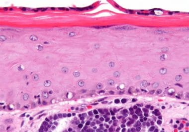 Increasing Immunotherapy Options for Rare Skin Cancer