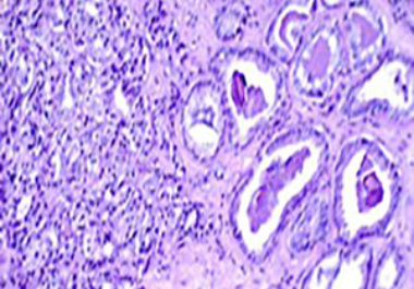 Prostate Cancer Disparities: Race-related Biological Differences