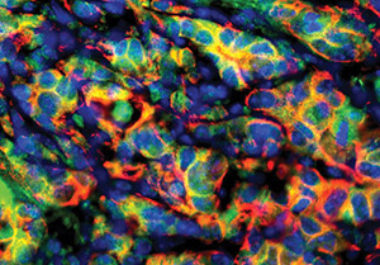 Upcoming AACR Meeting Focuses on Recent Advances in Pancreatic Cancer Research