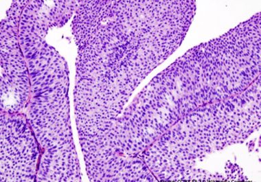 Targeting Bladder Cancer