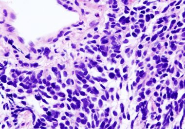 Combining Immunotherapy and Chemotherapy for Lung Cancer