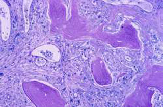 Fedratinib myelofibrosis