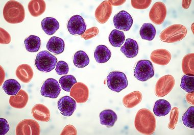 A New CAR-T Cell Therapy for Advanced B-cell Acute Lymphoblastic Leukemia  