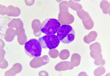 New Targeted Therapy for Acute Myeloid Leukemia 