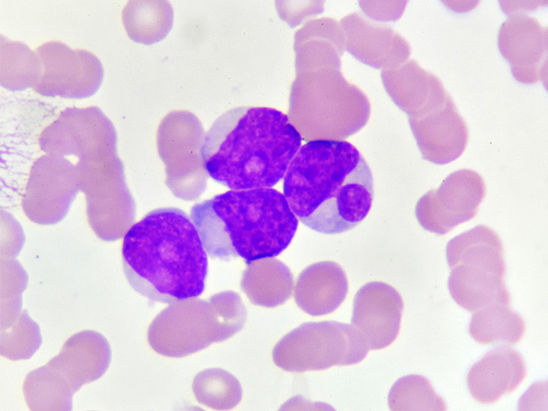Acute myeloid leukemia cells (AML)