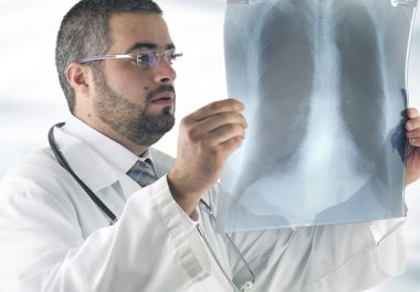 Do Statins Lower the Risk of Lung Cancer Death?