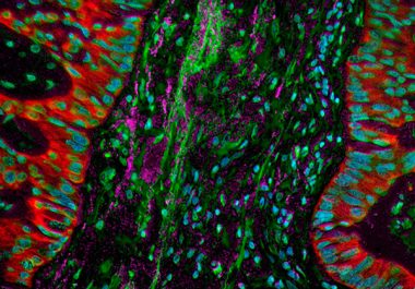 Combining Targeted Therapies for Lung Cancer