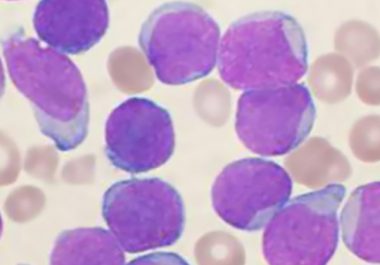 Groundbreaking New Immunotherapy Approved for Acute Lymphoblastic Leukemia (ALL)