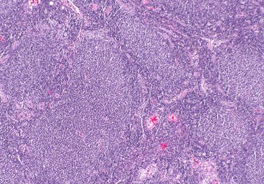 Targeting Non-Hodgkin Lymphoma