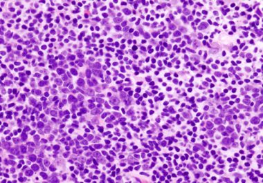 FDA Approves Second CAR T-cell Immunotherapy