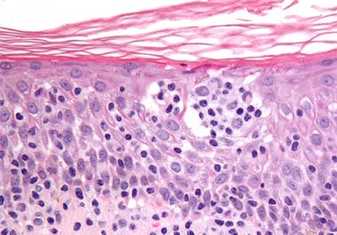 Expanding Molecularly Targeted Therapy to Additional Types of Lymphoma