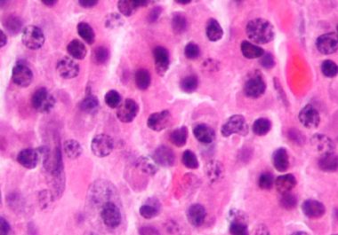 Preventing Bone Complications for Multiple Myeloma Patients