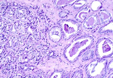 Keeping Prostate Cancer at Bay