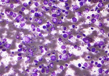 Expanding the Use of a CAR T-cell Immunotherapy