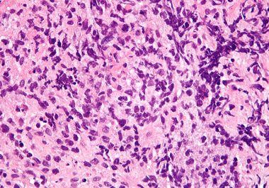 A New Immunotherapeutic for Non-Hodgkin Lymphoma