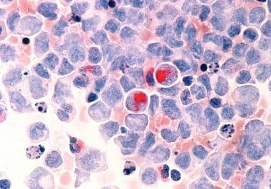 A New Molecularly Targeted Therapeutic for Acute Myeloid Leukemia