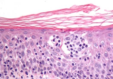 First Immunotherapeutic for Rare Types of Non-Hodgkin Lymphoma