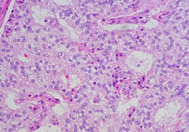 Targeted Radiotherapy for Neuroendocrine Tumors