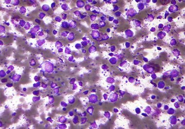 Targeting Non-Hodgkin Lymphoma