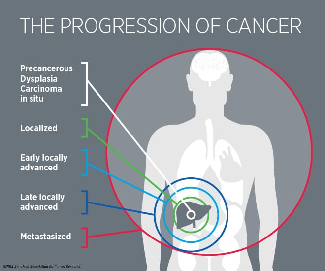 does cancer always travel up