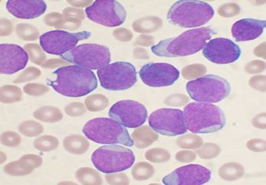 AACR’s Latest Journal, Blood Cancer Discovery, Publishes First Paper