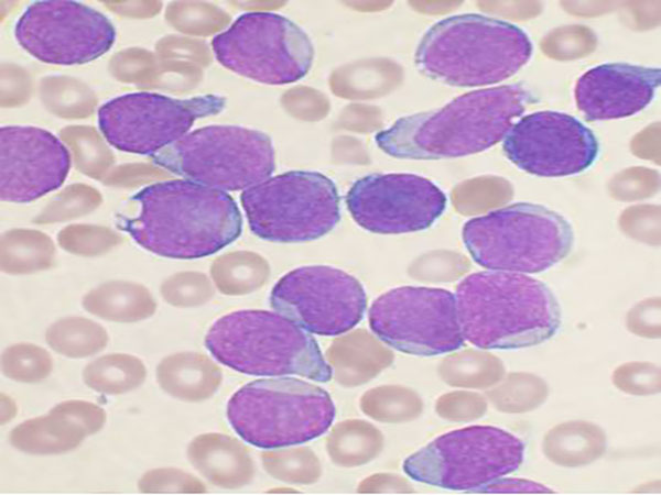 AACR’s Latest Journal, Blood Cancer Discovery, Publishes First Paper