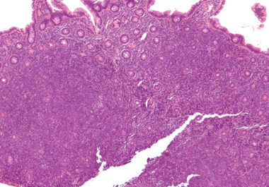 Targeted Therapeutic Approved to Treat a Form of Lymphoma