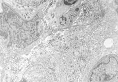 Treatment for Rare Type of Soft Tissue Sarcoma